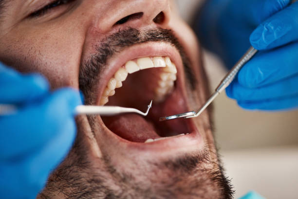 Best Teeth Whitening  in Marks, MS
